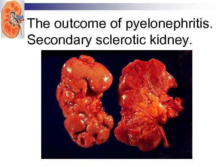 The outcome of pyelonephritis. Secondary sclerotic kidney. 