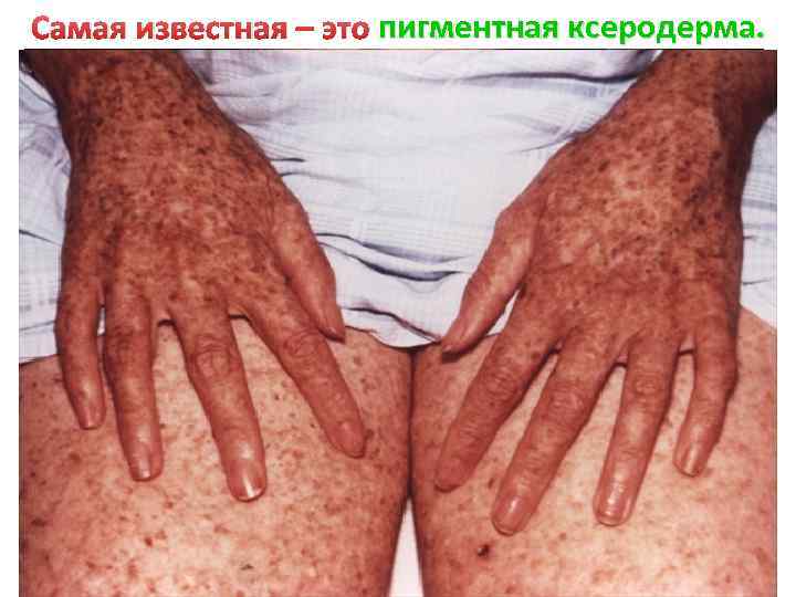 пигментная ксеродерма. Самая известная – это пигментная ксеродерма. заболевании При заболевании солнечный свет повреждает