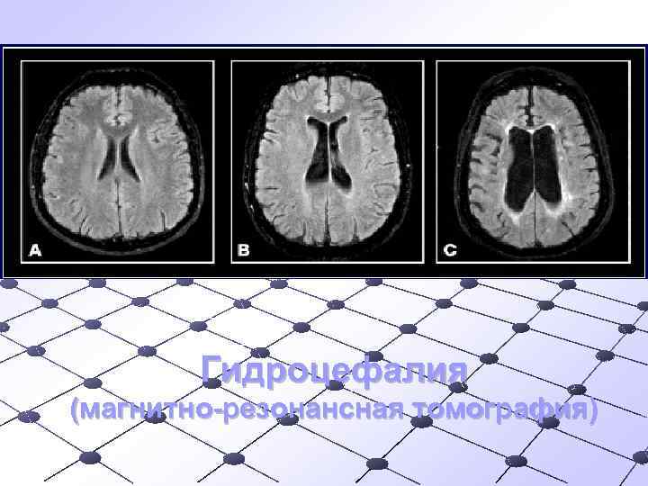 Гидроцефалия (магнитно-резонансная томография) 