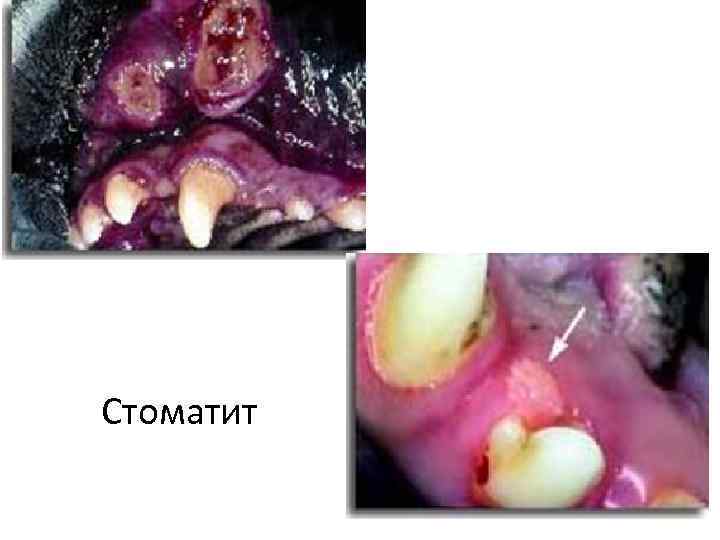 Стоматит 