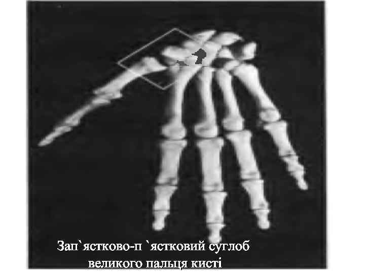 Зап`ястково-п `ястковий суглоб великого пальця кисті 
