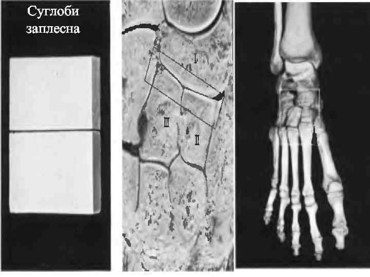 Суглоби заплесна 