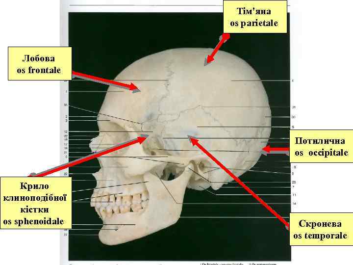 Тім'яна оs parietale Лобова os frontale Потилична os occipitale Крило клиноподібної кістки оs sphenoidale