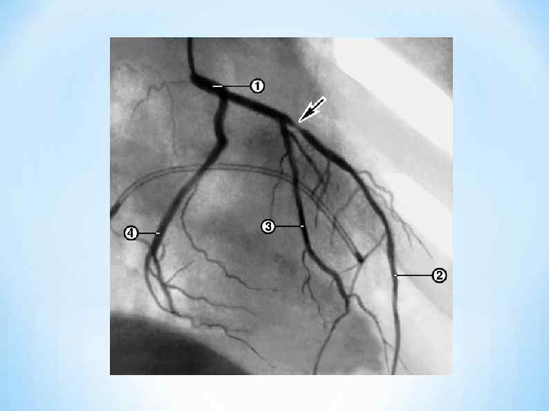 Стеноз артерий сердца. Коронарография стеноз ПМЖВ. Стентирование устья ПМЖВ. Окклюзия коронарной артерии на коронарографии. Окклюзия ствола левой коронарной артерии ЭКГ.