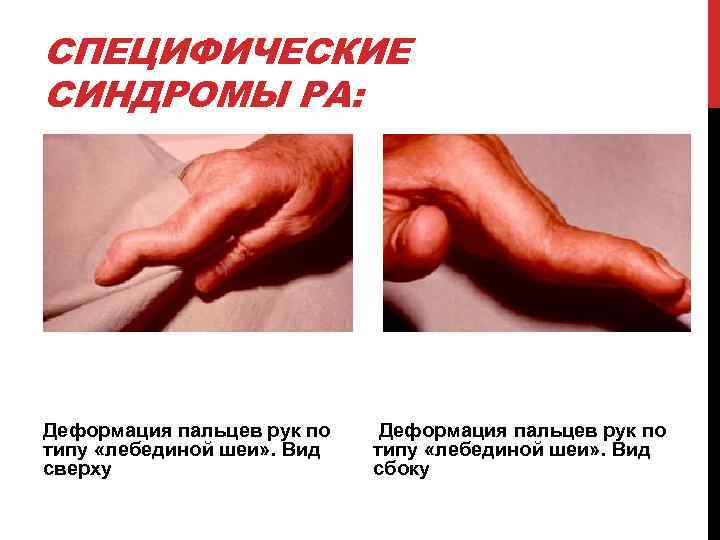 СПЕЦИФИЧЕСКИЕ СИНДРОМЫ РА: Деформация пальцев рук по типу «лебединой шеи» . Вид сверху Деформация
