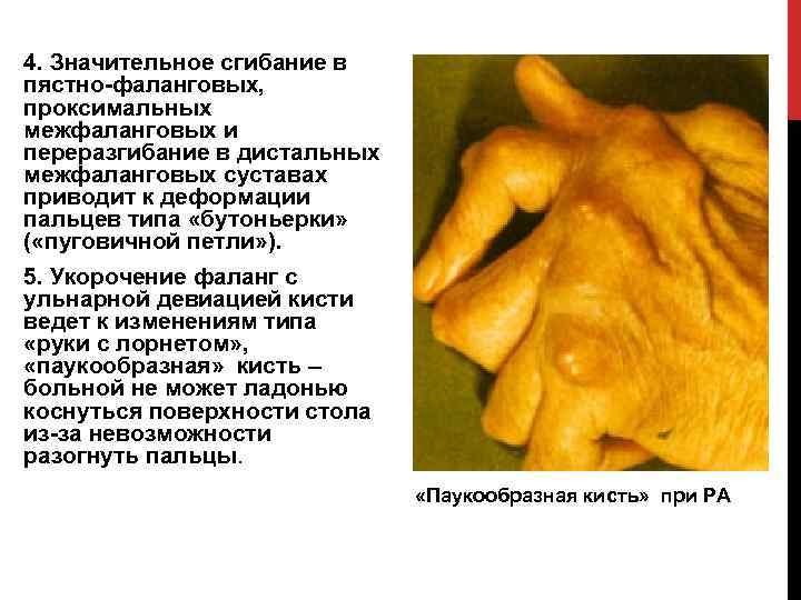 4. Значительное сгибание в пястно фаланговых, проксимальных межфаланговых и переразгибание в дистальных межфаланговых суставах