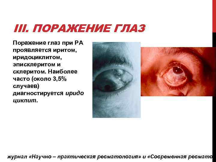 III. ПОРАЖЕНИЕ ГЛАЗ Поражение глаз при РА проявляется иритом, иридоциклитом, эписклеритом и склеритом. Наиболее