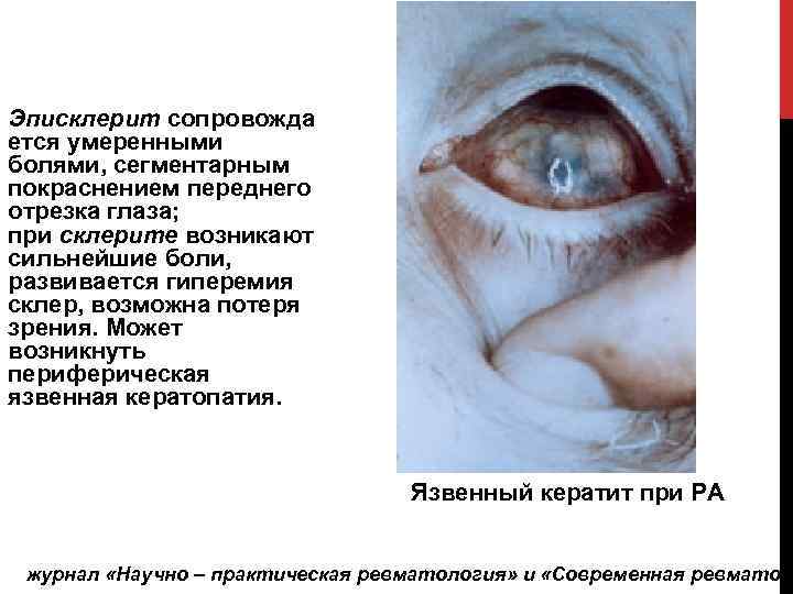 Эписклерит сопровожда ется умеренными болями, сегментарным покраснением переднего отрезка глаза; при склерите возникают сильнейшие