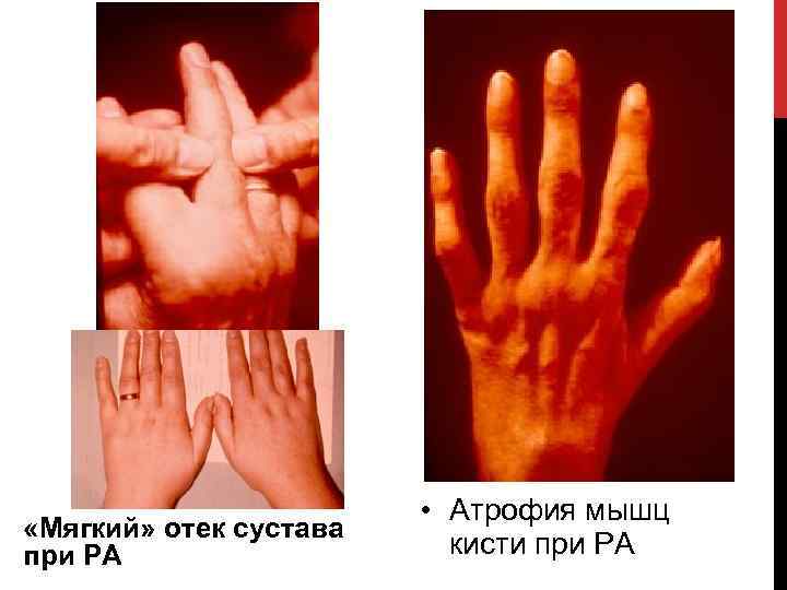  «Мягкий» отек сустава при РА • Атрофия мышц кисти при РА 