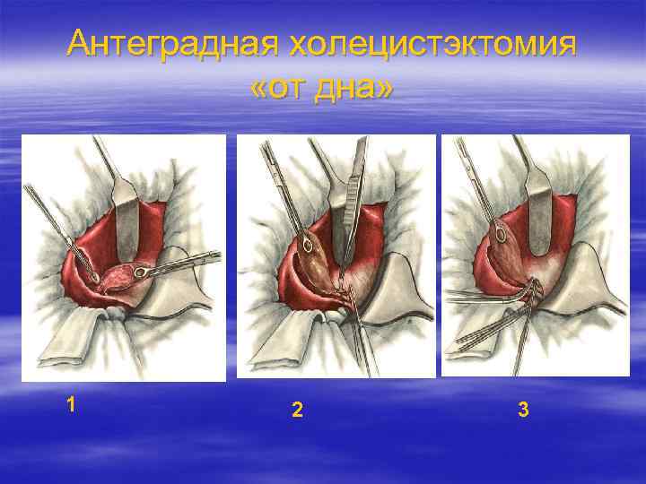 Антеградная холецистэктомия «от дна» 1 2 3 
