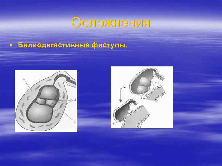 Осложнения § Билиодигестивные фистулы. 