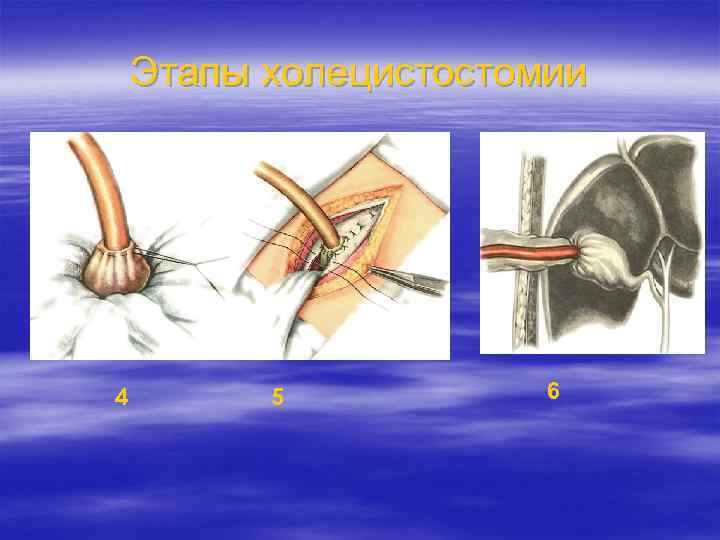 Этапы холецистостомии 4 5 6 