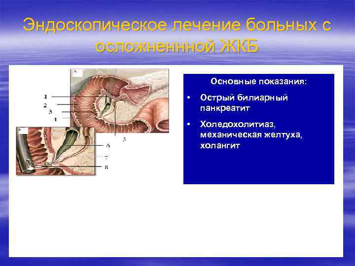 Эндоскопическое лечение больных с осложненнной ЖКБ Основные показания: • Острый билиарный панкреатит • Холедохолитиаз,