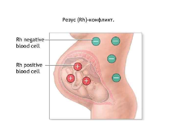 Резус (Rh)-конфликт. 