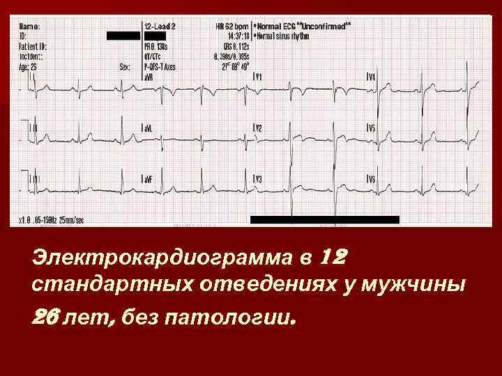 Электрокардиограмма в 12 стандартных отведениях у мужчины 26 лет, без патологии. 