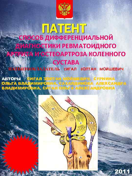 ПАТЕНТ СПОСОБ ДИФФЕРЕНЦИАЛЬНОЙ ДИАГНОСТИКИ РЕВМАТОИДНОГО АРТРИТА И ОСТЕОАРТРОЗА КОЛЕННОГО СУСТАВА ПАТЕНТООБЛАДАТЕЛЬ СИГАЛ ЗОЛТАН МОЙШЕВИЧ