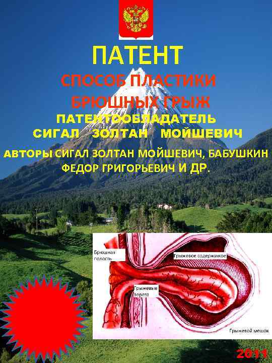 ПАТЕНТ СПОСОБ ПЛАСТИКИ БРЮШНЫХ ГРЫЖ ПАТЕНТООБЛАДАТЕЛЬ СИГАЛ ЗОЛТАН МОЙШЕВИЧ АВТОРЫ СИГАЛ ЗОЛТАН МОЙШЕВИЧ, БАБУШКИН