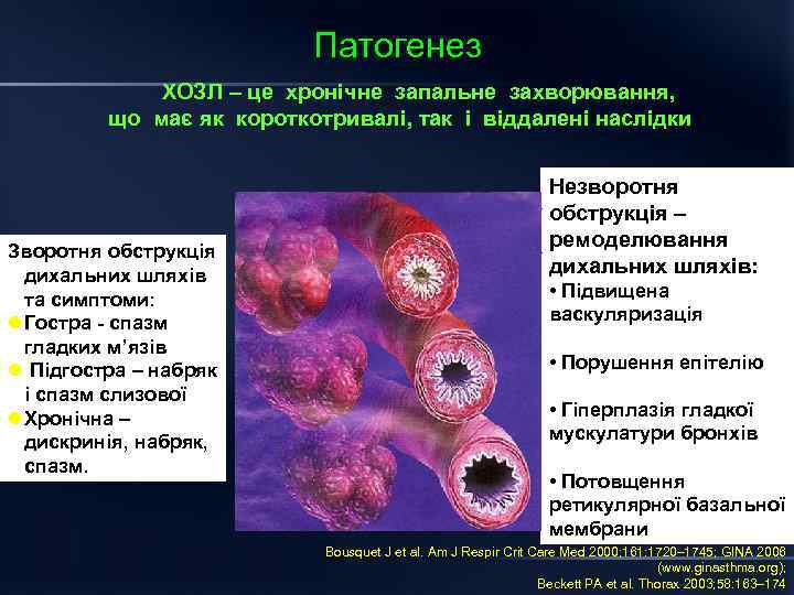 Патогенез ХОЗЛ – це хронічне запальне захворювання, що має як короткотривалі, так і віддалені