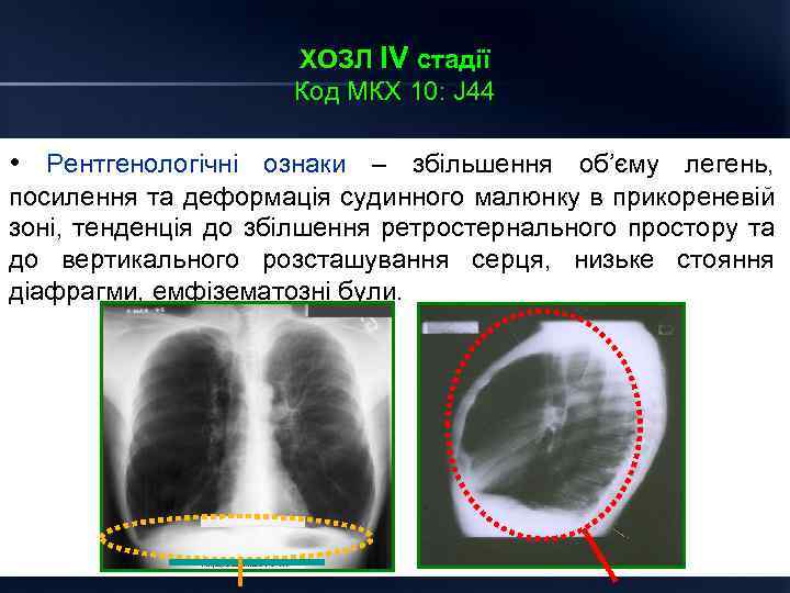 ХОЗЛ ІV стадії Код МКХ 10: J 44 • Рентгенологічні ознаки – збільшення об’єму