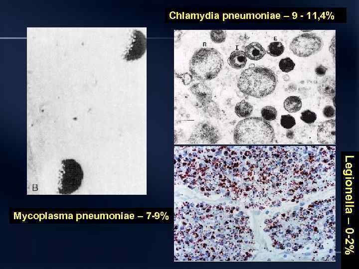 Chlamydia pneumoniae – 9 11, 4% Legionella – 0 2% Mycoplasma pneumoniae – 7