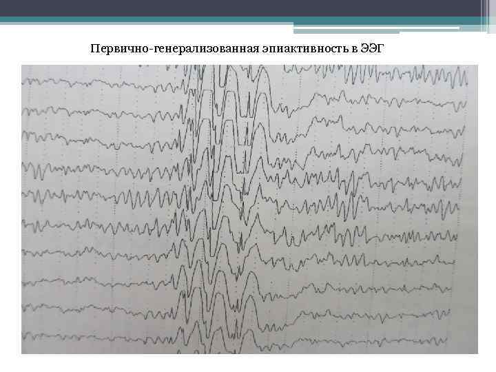 Ээг показывает эпилепсию. Эпилептиформная активность на ЭЭГ. Электроэнцефалография патология. Эпилептический статус ЭЭГ. Мультифокальная эпилепсия ЭЭГ.