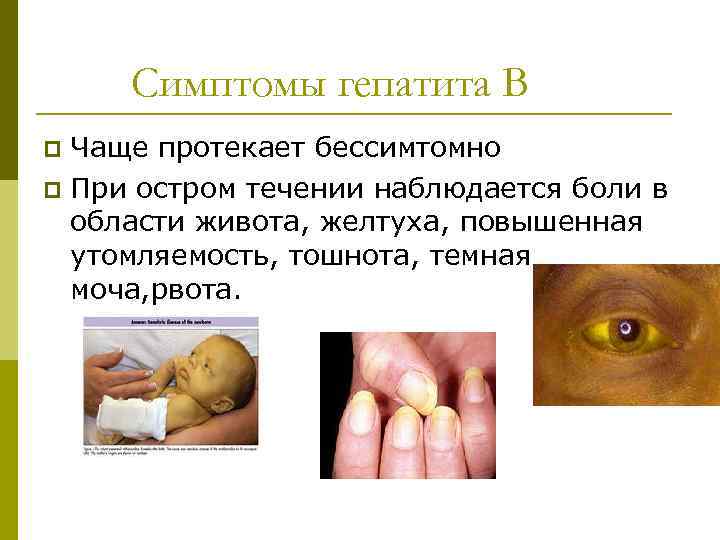 Симптомы гепатита В Чаще протекает бессимтомно p При остром течении наблюдается боли в области