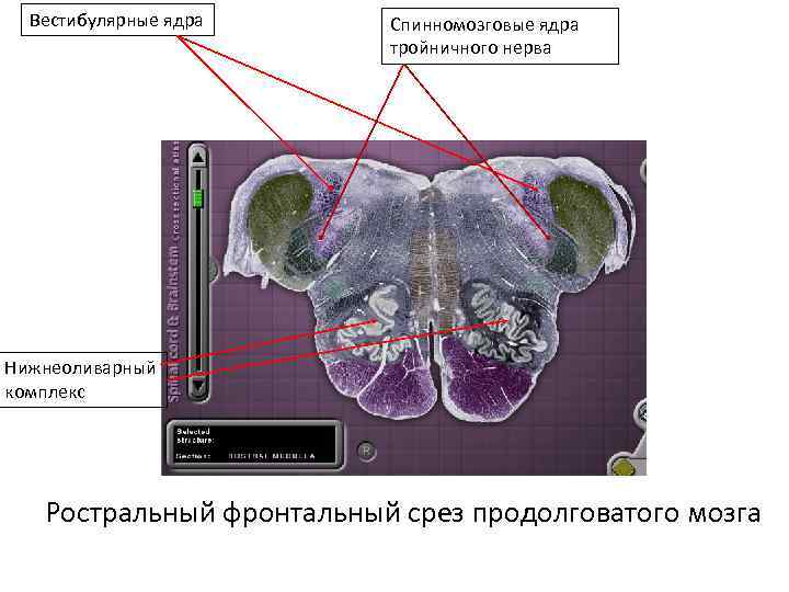Вестибулярные ядра Спинномозговые ядра тройничного нерва Нижнеоливарный комплекс Ростральный фронтальный срез продолговатого мозга 