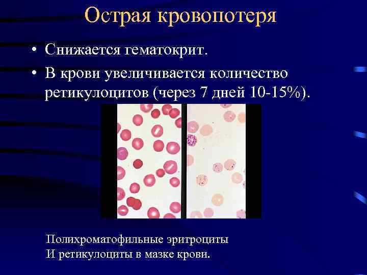 Острая кровопотеря • Снижается гематокрит. • В крови увеличивается количество ретикулоцитов (через 7 дней