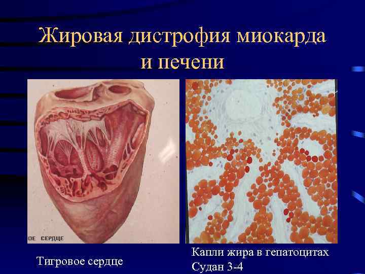 Жировая дистрофия миокарда и печени Тигровое сердце Капли жира в гепатоцитах Судан 3 -4