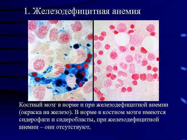 1. Железодефицитная анемия Костный мозг в норме и при железодефицитной анемии (окраска на железо).