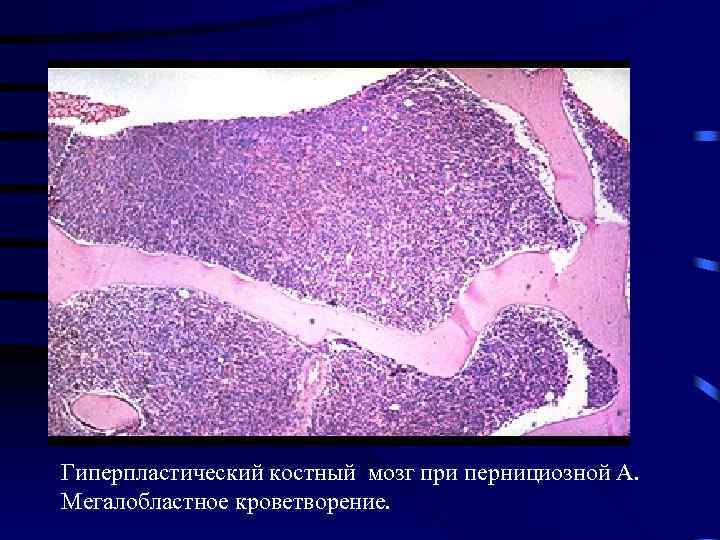 Изменения в организме • Меглобластная анемия • Гиперпластический костный мозг при пернициозной А. Мегалобластное