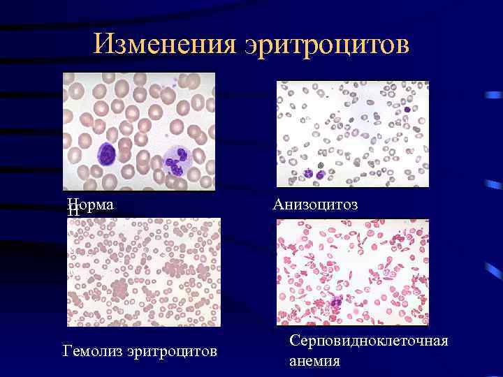 Изменения эритроцитов Норма Н о р м Гемолиз эритроцитов Анизоцитоз Серповидноклеточная анемия 