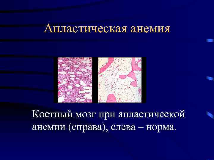 Апластическая анемия Костный мозг при апластической анемии (справа), слева – норма. 