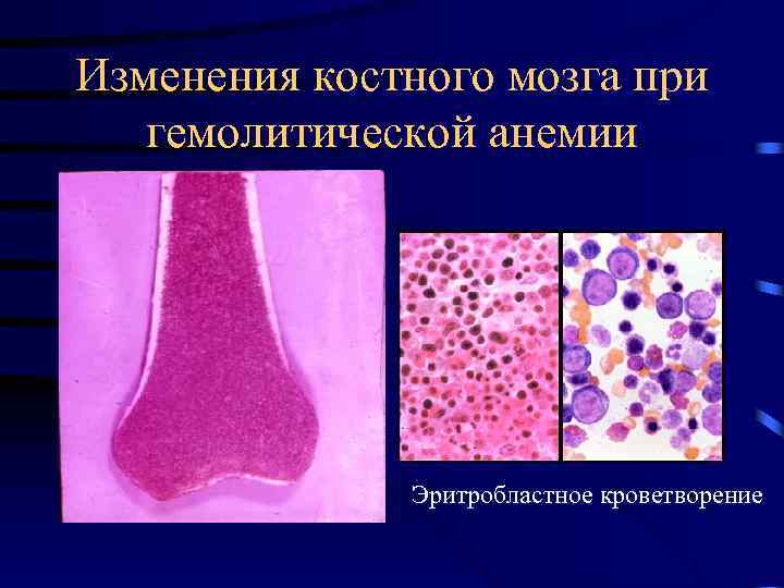 Изменения костного мозга при гемолитической анемии Эритробластное кроветворение 