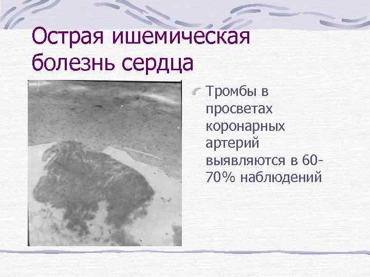 Острая ишемическая болезнь сердца Тромбы в просветах коронарных артерий выявляются в 6070% наблюдений 