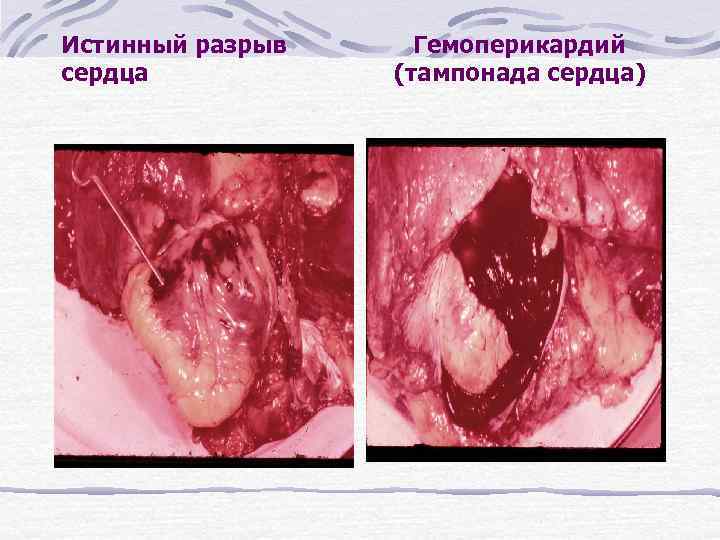 Истинный разрыв сердца Гемоперикардий (тампонада сердца) 