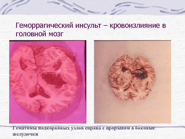 Геморрагический инсульт – кровоизлияние в головной мозг Гематомы подкорковых узлов справа с прорывом в