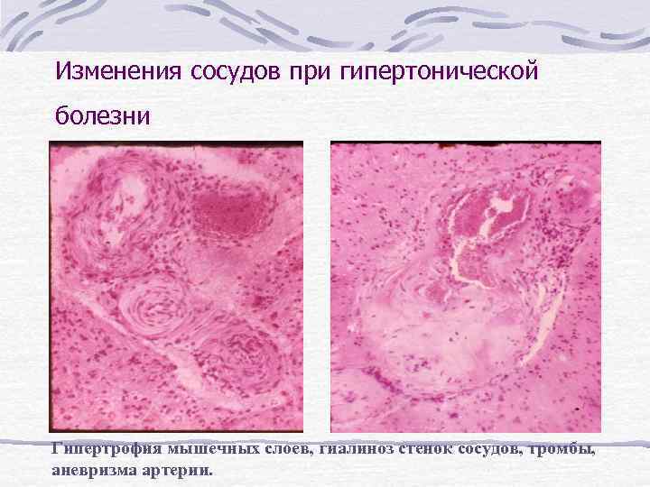 Изменения сосудов при гипертонической болезни Гипертрофия мышечных слоев, гиалиноз стенок сосудов, тромбы, аневризма артерии.