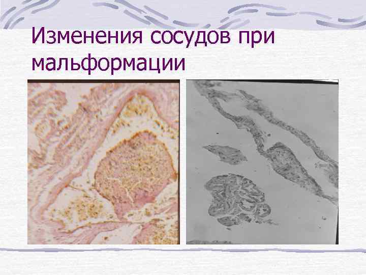 Изменения сосудов при мальформации 