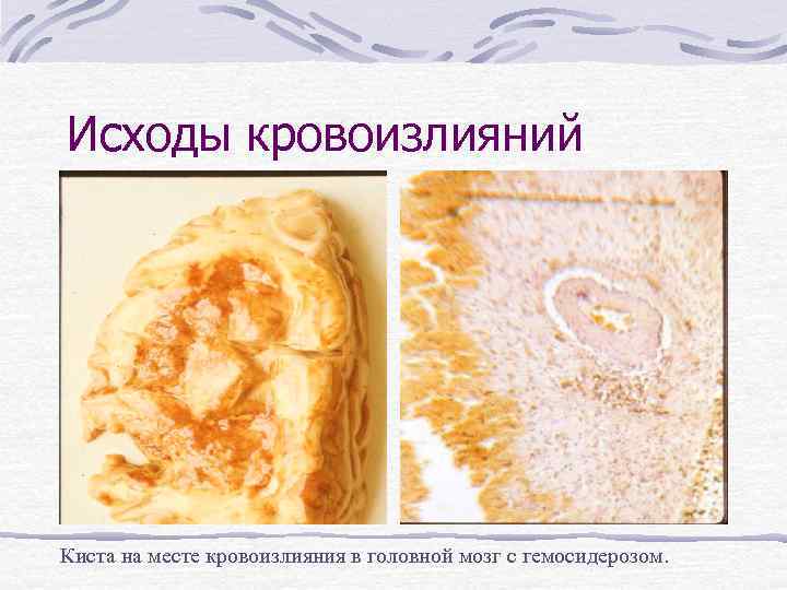 Исходы кровоизлияний Киста на месте кровоизлияния в головной мозг с гемосидерозом. 