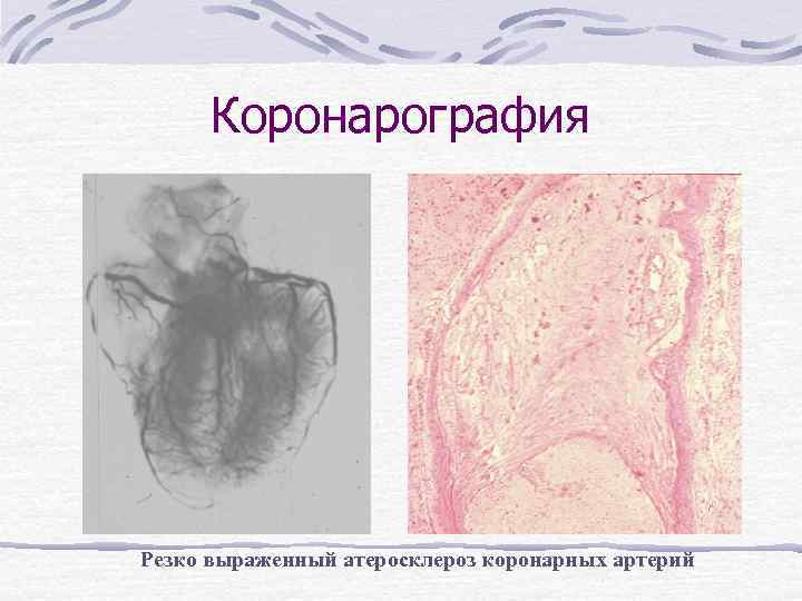Коронарография Резко выраженный атеросклероз коронарных артерий 