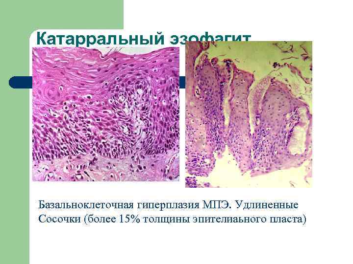 Катарральный эзофагит Базальноклеточная гиперплазия МПЭ. Удлиненные Сосочки (более 15% толщины эпителиаьного пласта) 
