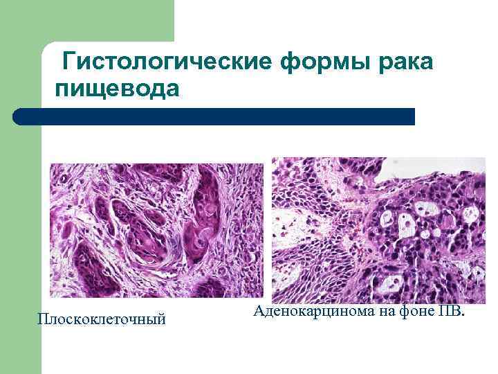  Гистологические формы рака пищевода Плоскоклеточный Аденокарцинома на фоне ПВ. 