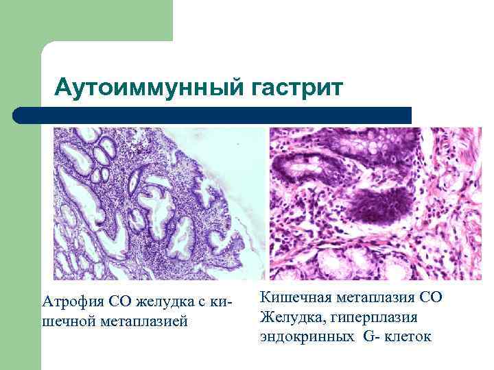 Аутоиммунный гастрит Атрофия СО желудка с кишечной метаплазией Кишечная метаплазия СО Желудка, гиперплазия эндокринных