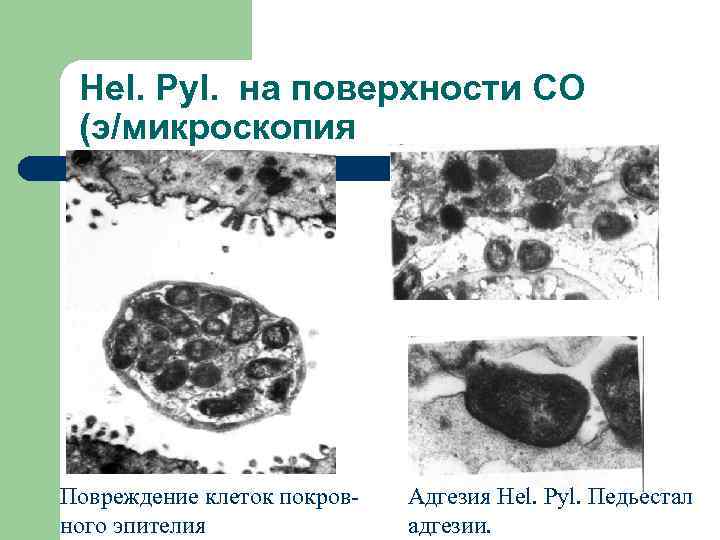Hel. Pyl. на поверхности СО (э/микроскопия Повреждение клеток покровного эпителия Адгезия Hel. Pyl. Педьестал