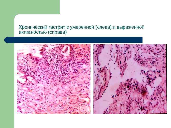 Хронический гастрит с умеренной (слева) и выраженной активностью (справа) 