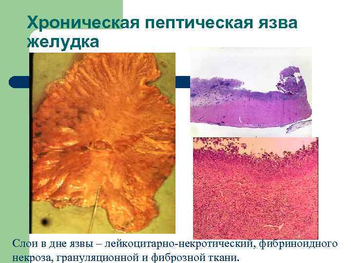 Хроническая пептическая язва желудка Слои в дне язвы – лейкоцитарно-некротический, фибриноидного некроза, грануляционной и