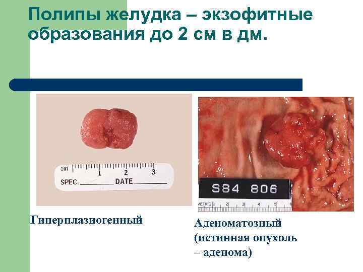 Полипы желудка – экзофитные образования до 2 см в дм. Гиперплазиогенный Аденоматозный (истинная опухоль