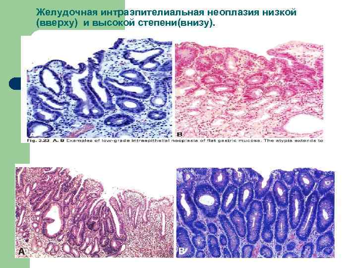 Желудочная интраэпителиальная неоплазия низкой (вверху) и высокой степени(внизу). 