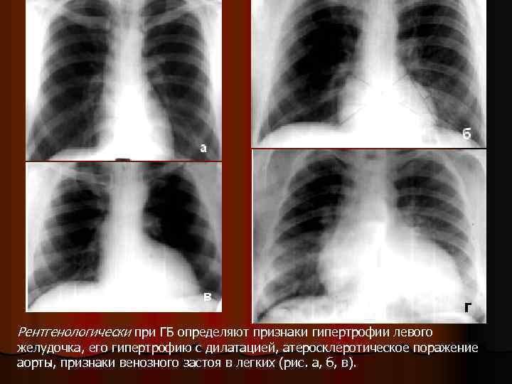 Рентгенологически при ГБ определяют признаки гипертрофии левого желудочка, его гипертрофию с дилатацией, атеросклеротическое поражение